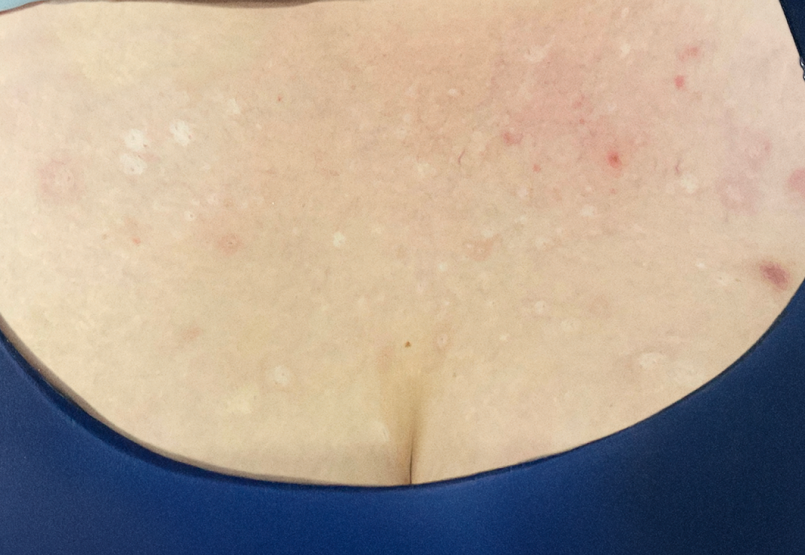 Female patient at Week 16 with healed prurigo nodularis nodules on the chest.