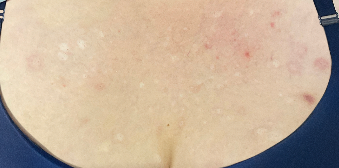 Female patient at Week 16 with healed prurigo nodularis nodules on the chest.