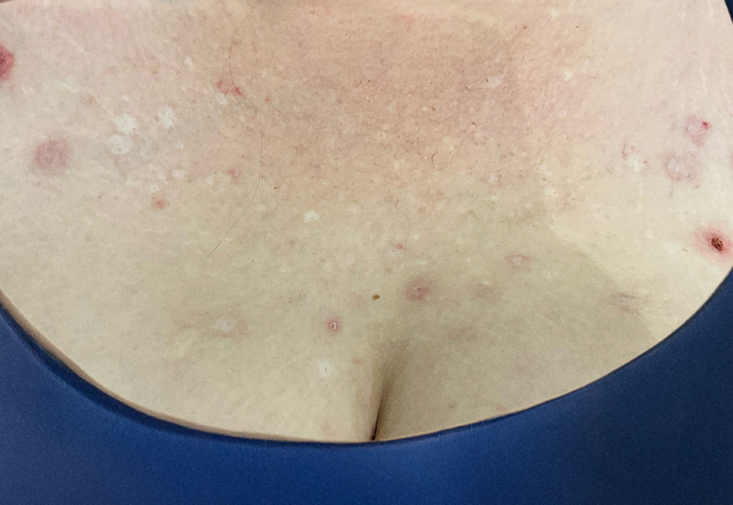 Female patient at baseline with prurigo nodularis nodules on the chest.