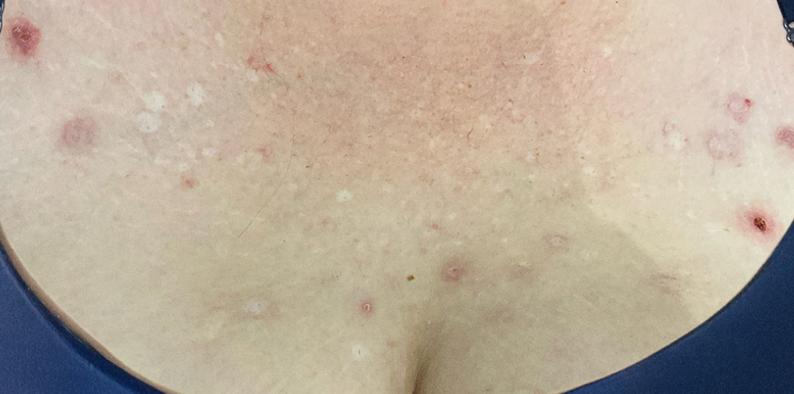 Female patient at baseline with prurigo nodularis nodules on the chest.