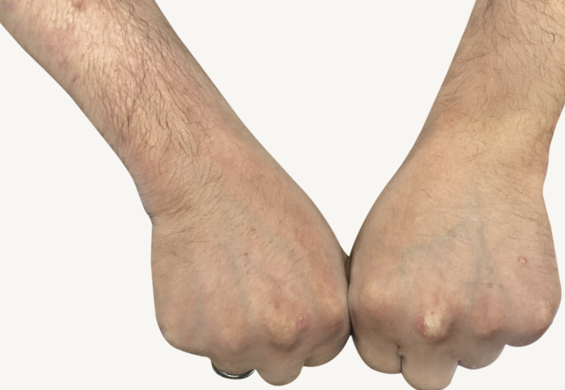Patient&nbsp;at&nbsp;Week&nbsp;16&nbsp;with&nbsp;healed prurigo&nbsp;nodularis&nbsp;nodules&nbsp;on&nbsp;the hands.