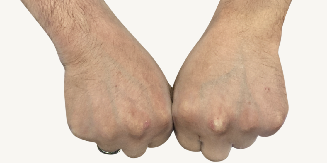 Patient at Week 16 with healed prurigo nodularis nodules on the hands.
