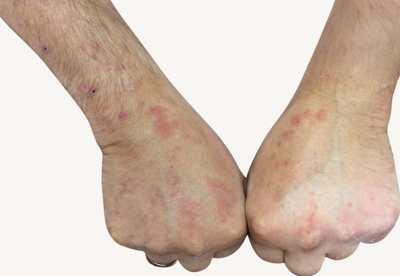 Patient&nbsp;at&nbsp;baseline&nbsp;with&nbsp;prurigo nodularis&nbsp;nodules&nbsp;on&nbsp;the&nbsp;hands.
