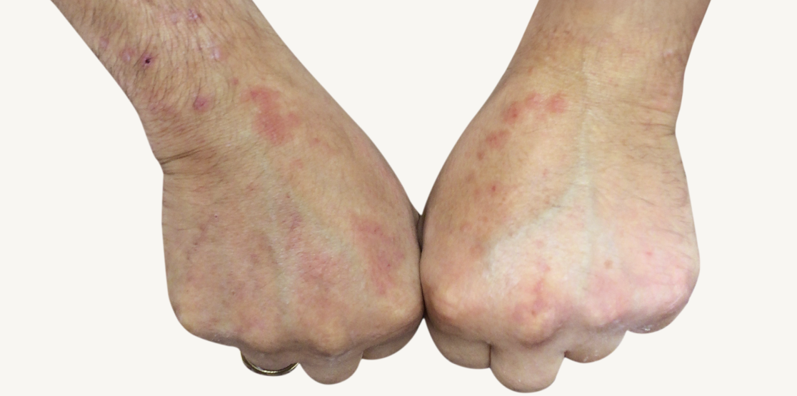 Patient at baseline with prurigo nodularis nodules on the hands.