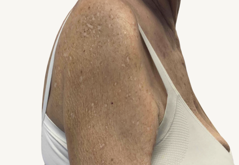 Female patient at Week 16 with healed prurigo nodularis nodules on the arms.