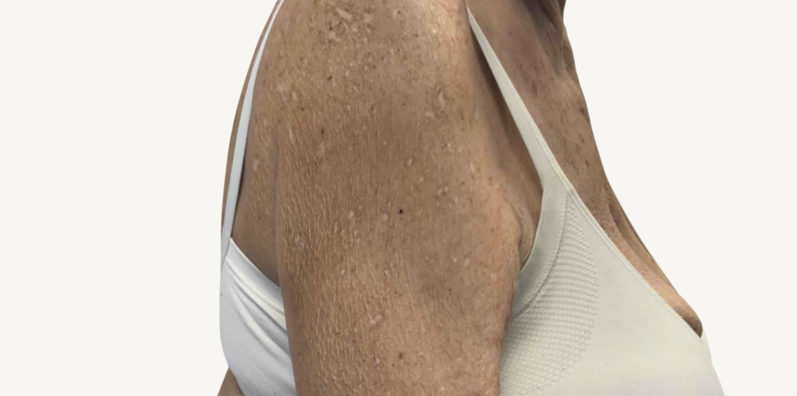 Female patient at Week 16 with healed prurigo nodularis nodules on the arms.
