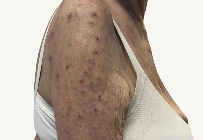 Female patient at baseline with prurigo nodularis nodules on the arms.