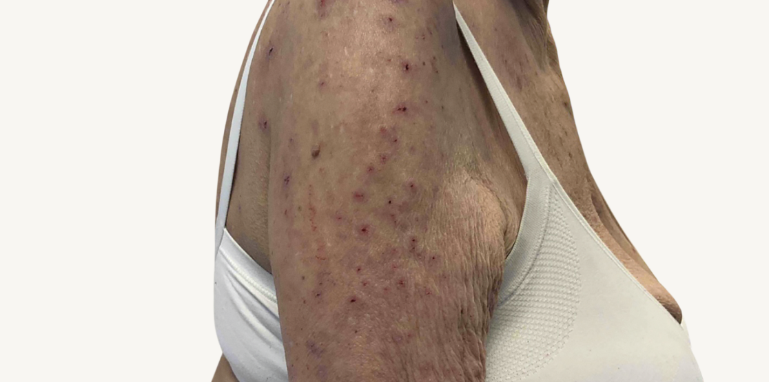 Female patient at baseline with prurigo nodularis nodules on the arms.