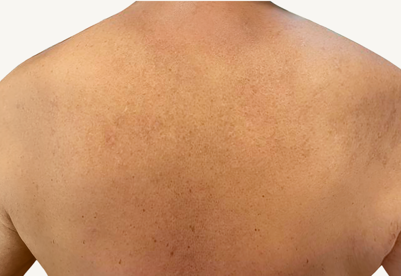 Male patient at Week 16 with healed prurigo nodularis nodules on the shoulders.