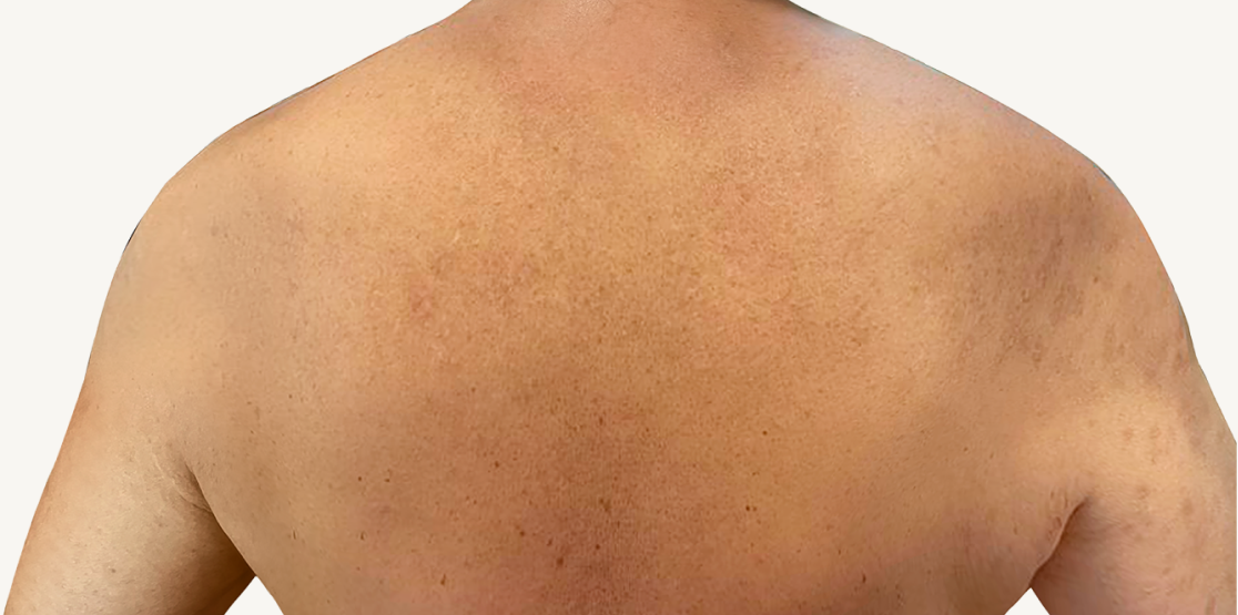 Male patient at Week 16 with healed prurigo nodularis nodules on the shoulders.
