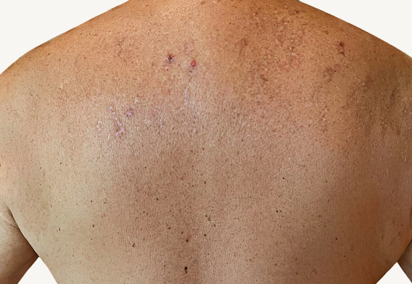 Male patient at baseline with prurigo nodularis nodules on the shoulders.