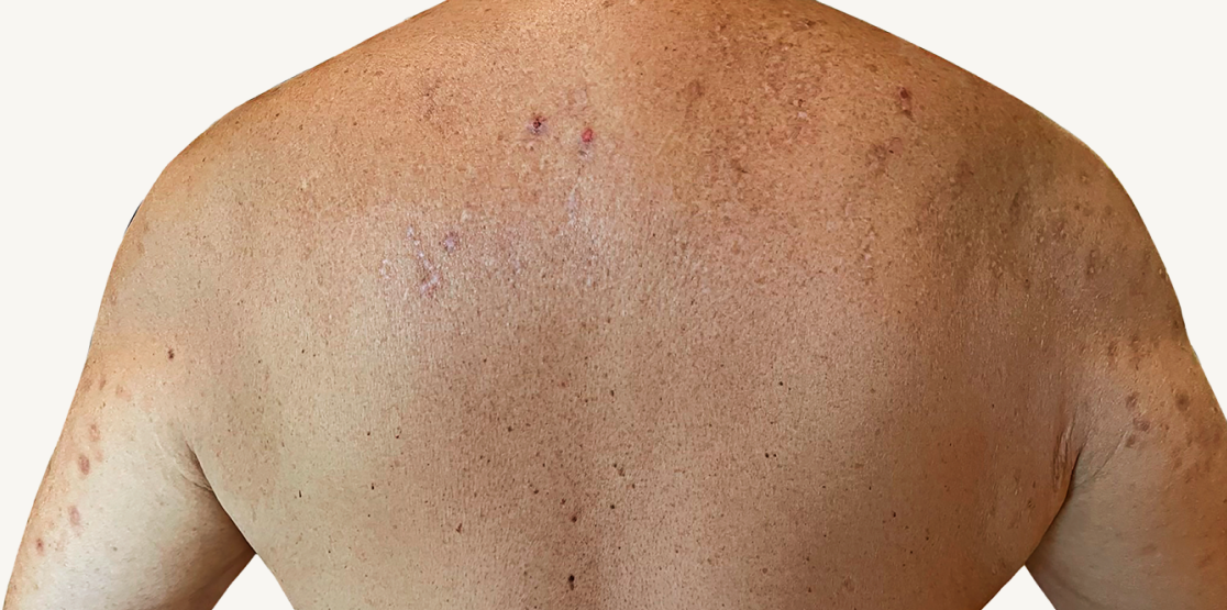 Male patient at baseline with prurigo nodularis nodules on the shoulders.