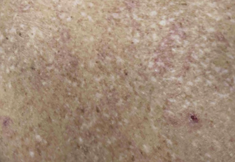 Female patient at Week 16 with healed prurigo nodularis nodules on the upper back.