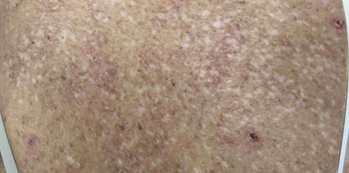 Female patient at Week 16 with healed prurigo nodularis nodules on the upper back.