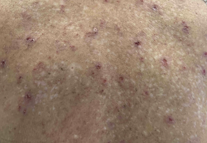 Female patient at baseline with prurigo nodularis nodules on the upper back.
