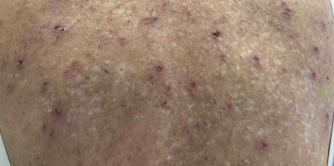 Female patient at baseline with prurigo nodularis nodules on the upper back.