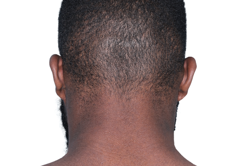 Actual 23-year-old male patient at Week 16 with improved atopic dermatitis on back of neck.