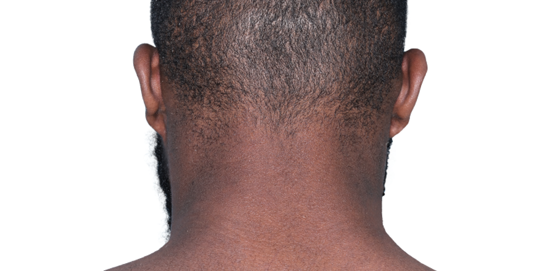 Actual 23-year-old male patient at Week 16 with improved atopic dermatitis on back of neck.
