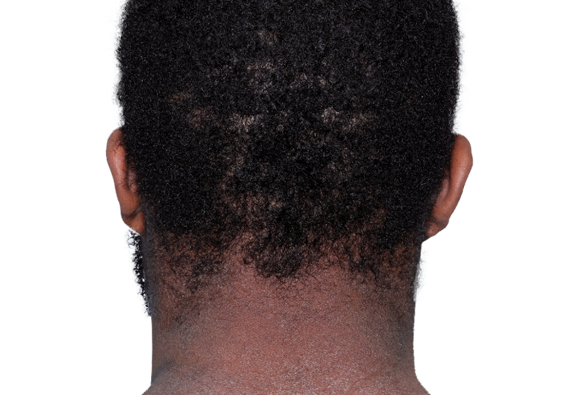 Actual 23-year-old male patient at baseline with atopic dermatitis on back of neck.