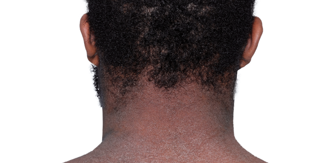 Actual 23-year-old male patient at baseline with atopic dermatitis on back of neck.
