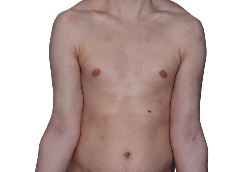 Actual 26-year-old male patient at Week 16 with improved atopic dermatitis on chest and arms.