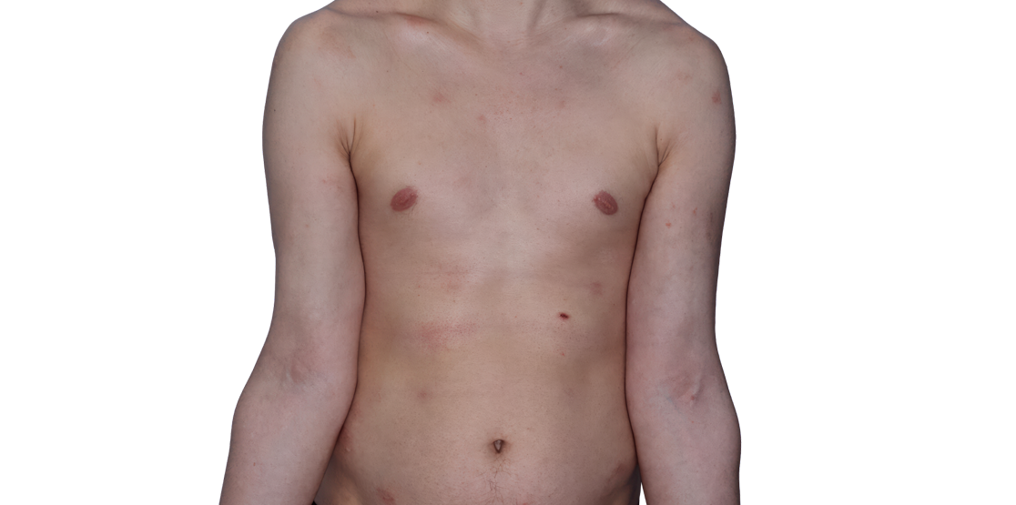 Actual 26-year-old male patient at Week 16 with improved atopic dermatitis on chest and arms.