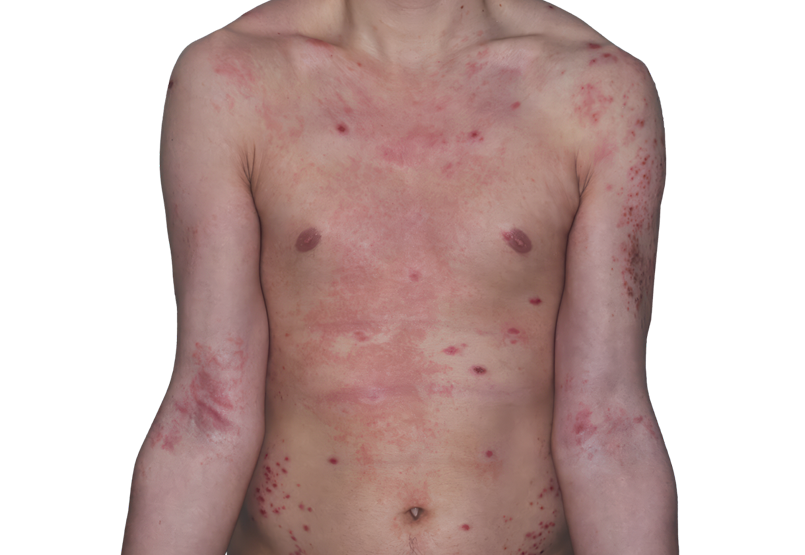 Actual 26-year-old male patient at baseline with atopic dermatitis on arms and chest.
