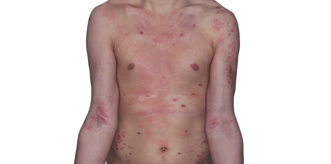 Actual 26-year-old male patient at baseline with atopic dermatitis on arms and chest.