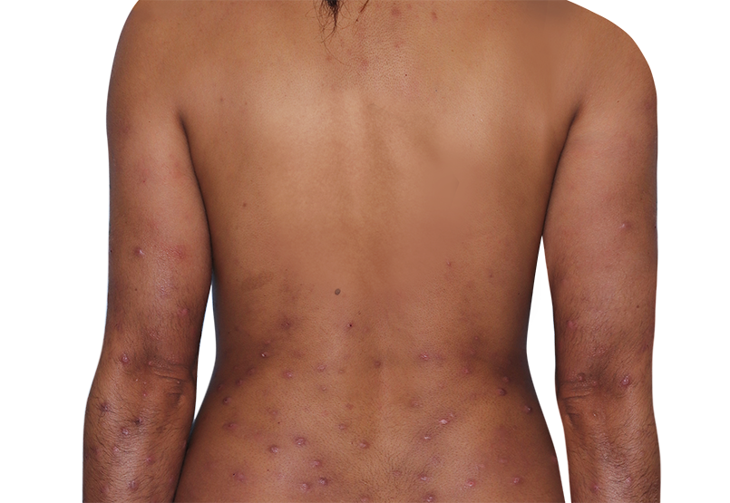 Image of an actual 31-year-old female patient at baseline with prurigo nodularis nodules on back and arms.