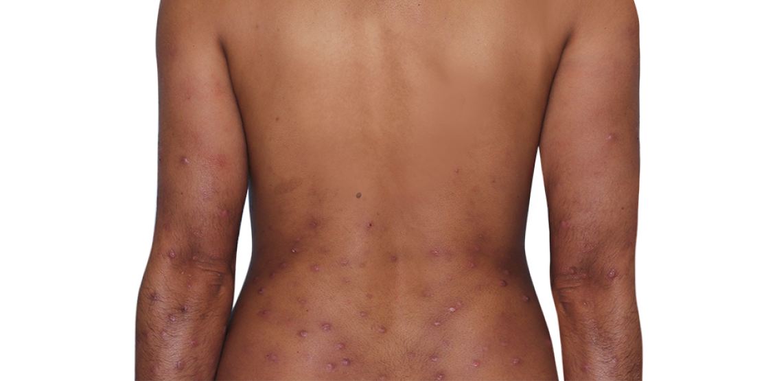 Image of an actual 31-year-old female patient at baseline with prurigo nodularis nodules on back and arms.