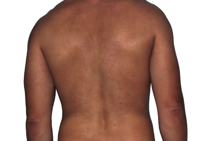 Actual 42-year-old male patient at Week 16 with improved atopic dermatitis on back and arms.