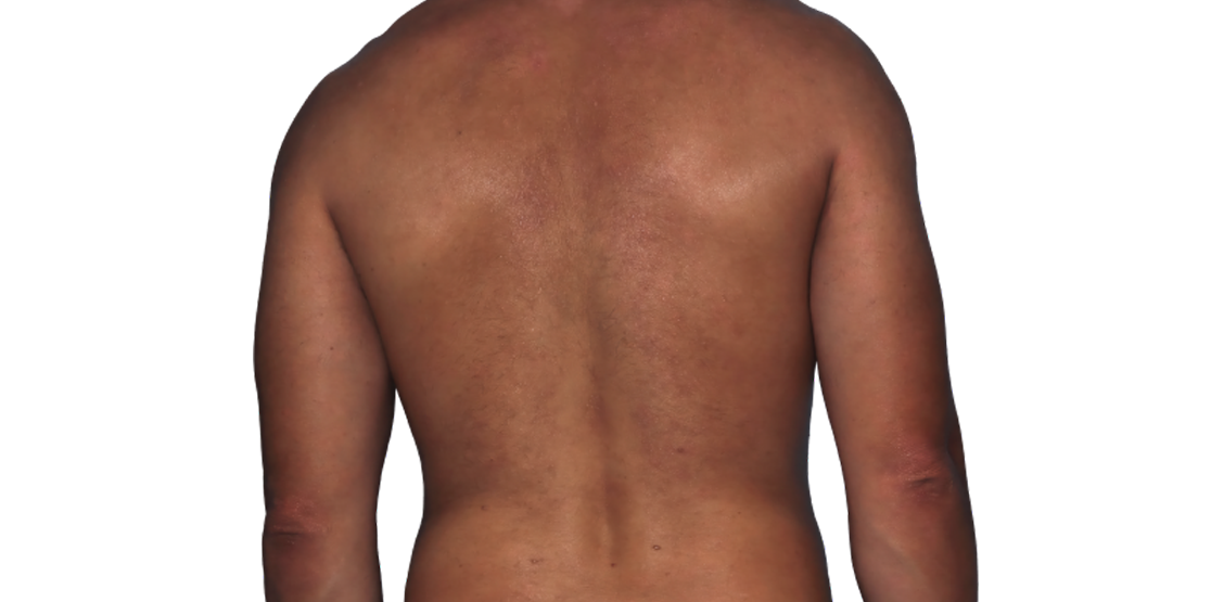 Actual 42-year-old male patient at Week 16 with improved atopic dermatitis on back and arms.