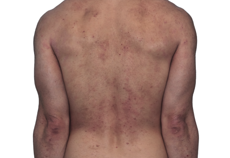 Actual 42-year-old male patient at baseline with atopic dermatitis on back and arms.