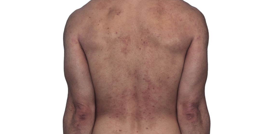 Actual 42-year-old male patient at baseline with atopic dermatitis on back and arms.