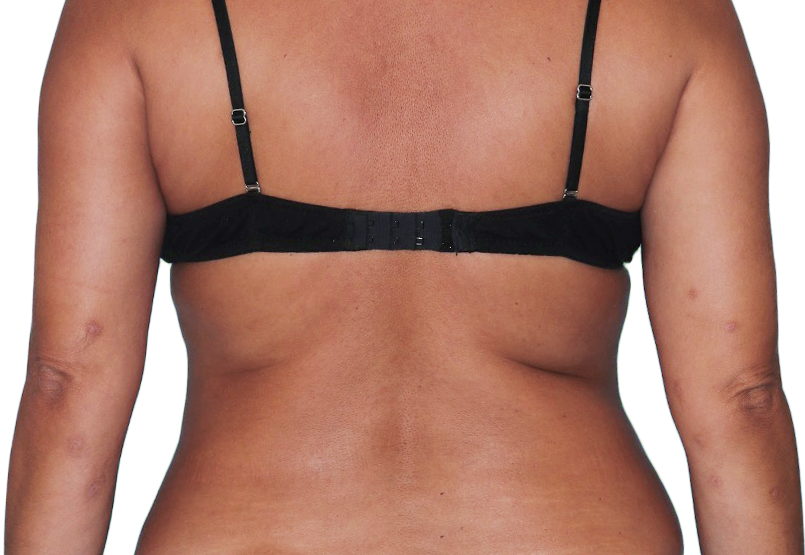 Image of an actual 43-year-old female patient with reduced raised bumps and nodules after NEMLUVIO® (nemolizumabilto) treatment for prurigo nodularis (PN).