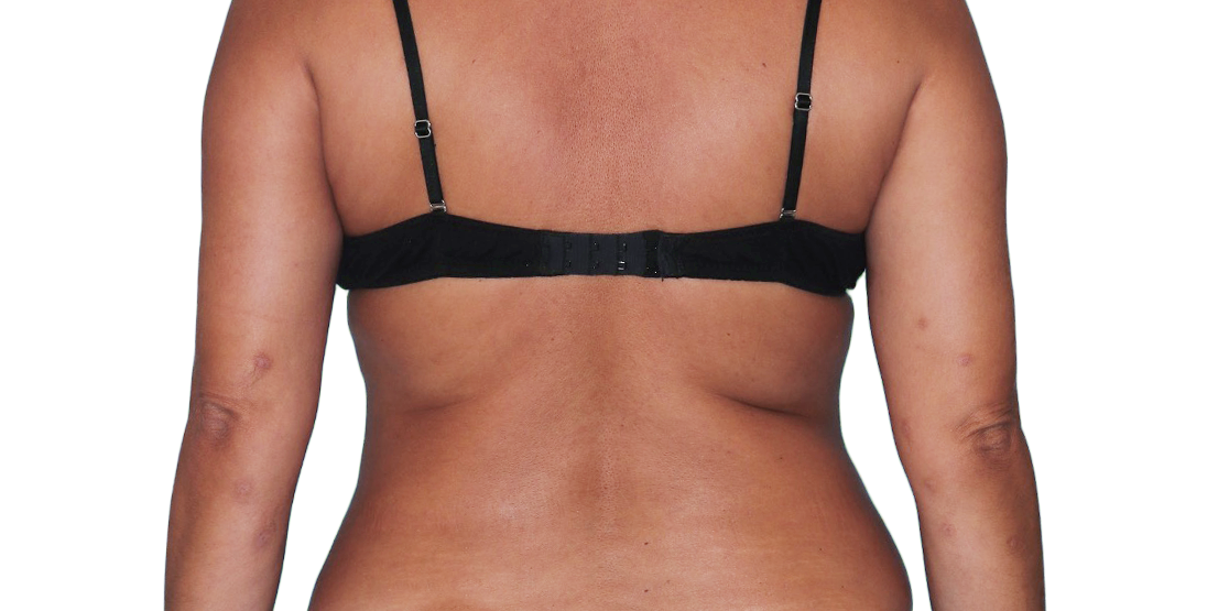 Image of an actual 43-year-old female patient with reduced raised bumps and nodules after NEMLUVIO® (nemolizumabilto) treatment for prurigo nodularis (PN).
