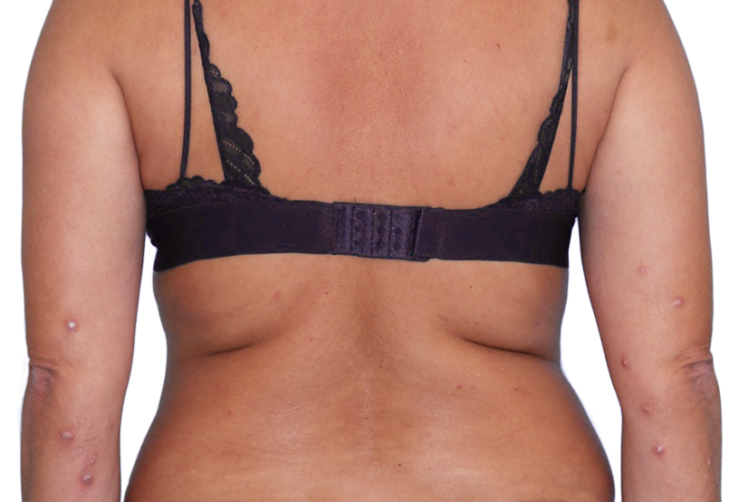 Image of an actual 43-year-old female patient at baseline with raised bumps and nodules before NEMLUVIO® (nemolizumab-ilto) treatment for prurigo nodularis (PN).
