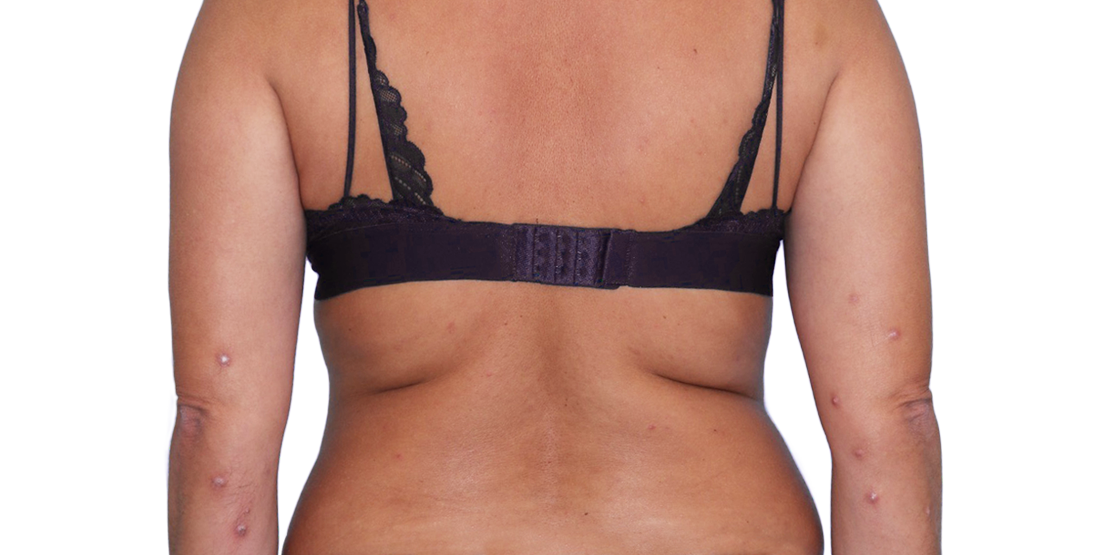 Image of an actual 43-year-old female patient at baseline with raised bumps and nodules before NEMLUVIO® (nemolizumab-ilto) treatment for prurigo nodularis (PN).