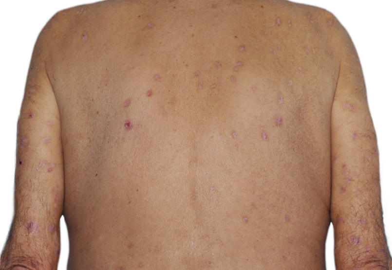 Image of an actual 73-year-old male patient with reduced raised bumps and nodules after NEMLUVIO® (nemolizumab-ilto) treatment for prurigo nodularis (PN).