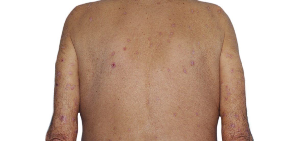 Image of an actual 73-year-old male patient with reduced raised bumps and nodules after NEMLUVIO® (nemolizumab-ilto) treatment for prurigo nodularis (PN).