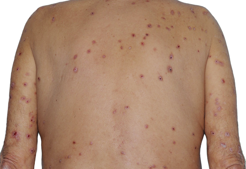 Image of an actual 73-year-old male patient at baseline with raised bumps and nodules before NEMLUVIO® (nemolizumab-ilto) treatment for prurigo nodularis (PN).