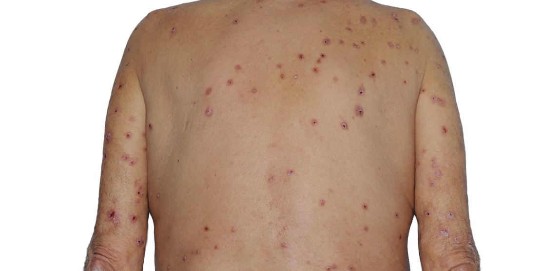 Image of an actual 73-year-old male patient at baseline with raised bumps and nodules before NEMLUVIO® (nemolizumab-ilto) treatment for prurigo nodularis (PN).